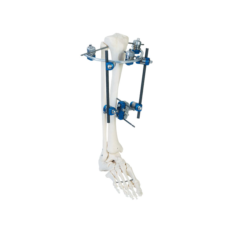 Proximal tibia symmetrical frame